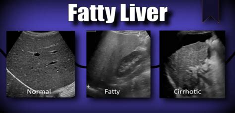 fibroscan interpretation|fibroscan vs ultrasound of liver.